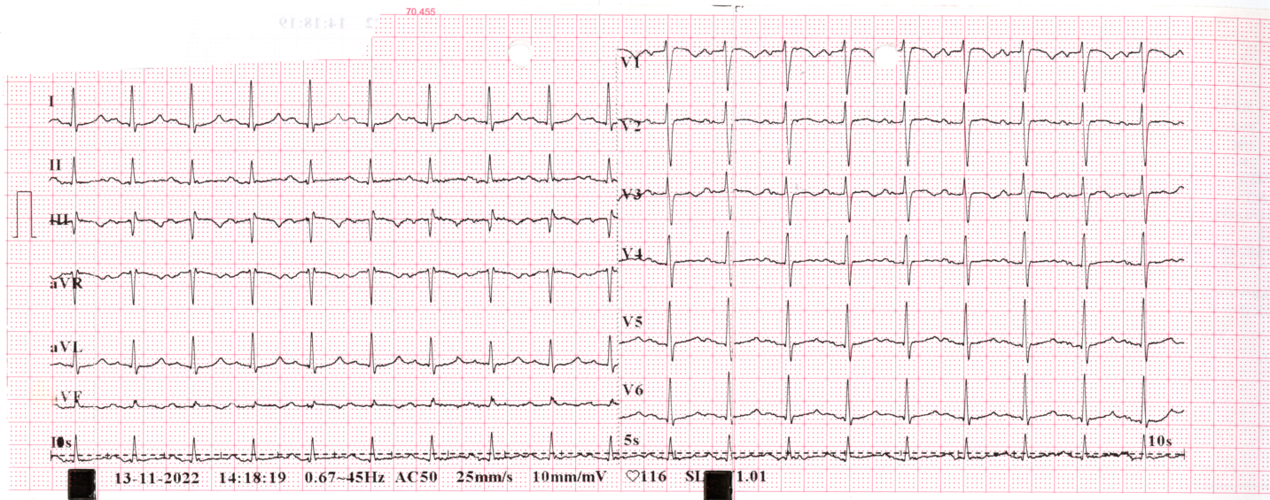 Przykład obrazu badania EKG