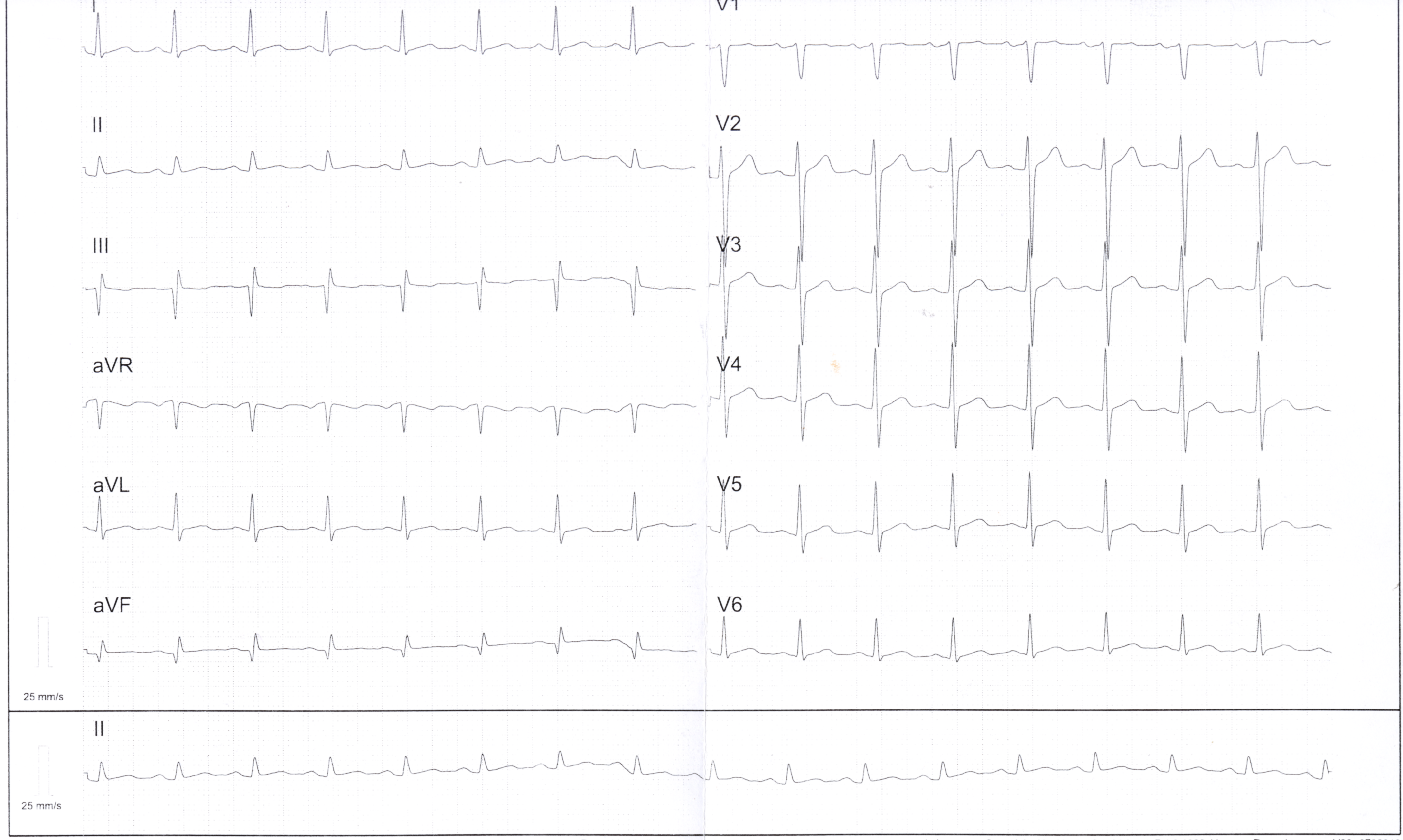 Przykład obrazu badania EKG