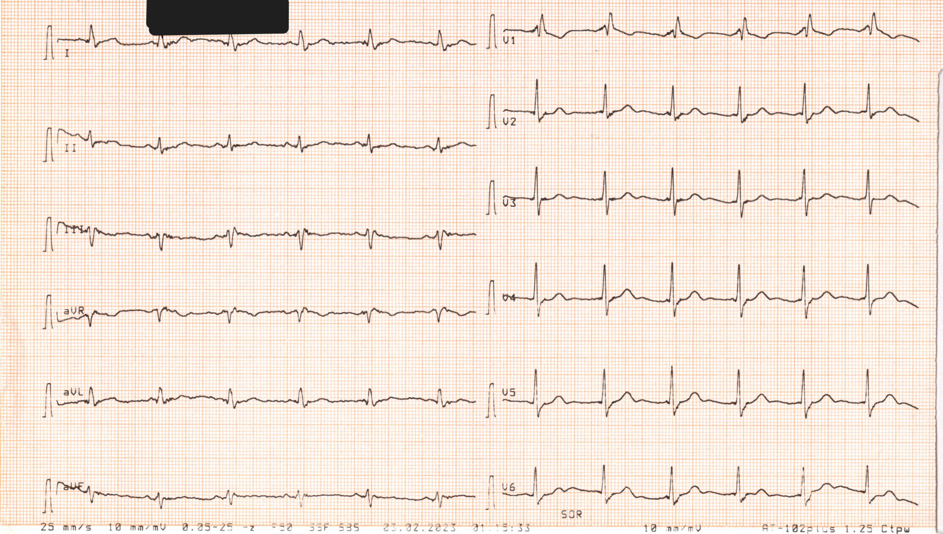 Przykład obrazu badania EKG