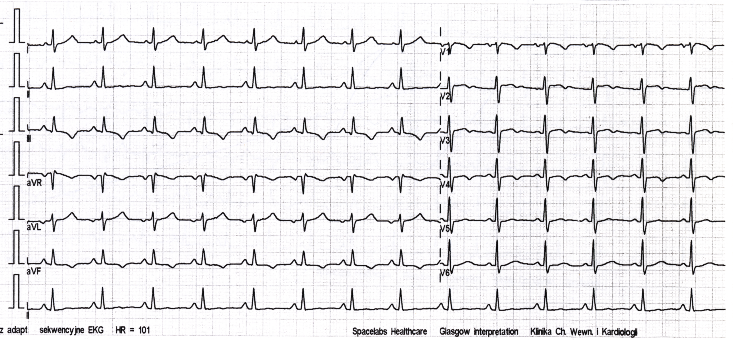 Przykład obrazu badania EKG